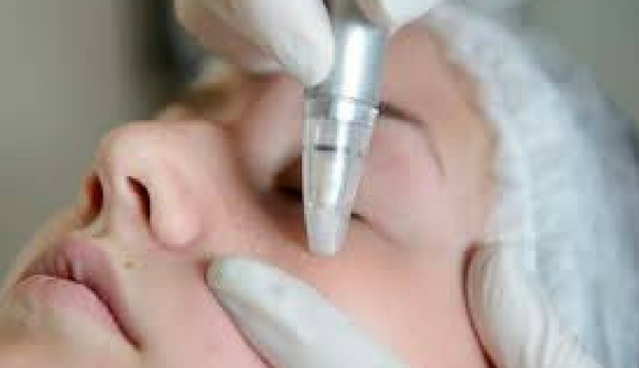 microdermabrasion