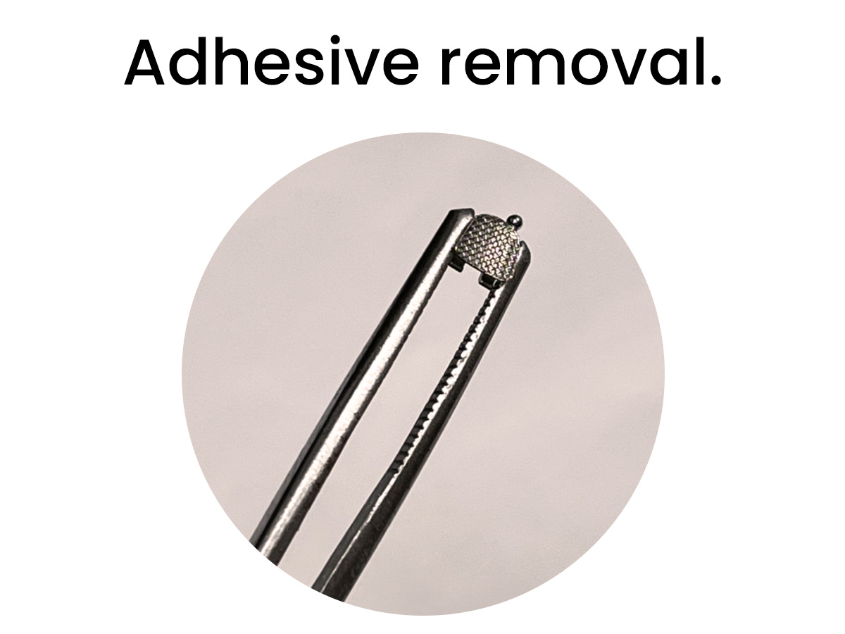 Ortho Bracket Adhesive Removal - Vaniman